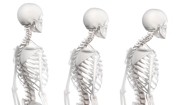 As we age, most of us start adopting a Kyphotic posture.