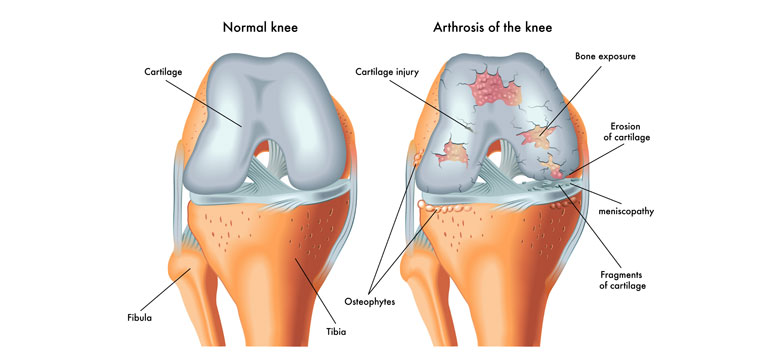 Comparing a normal knee and knee suffering from arthritis