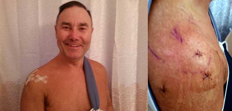 Bill, 62 years old, required shoulder surgery after a bicycle accident